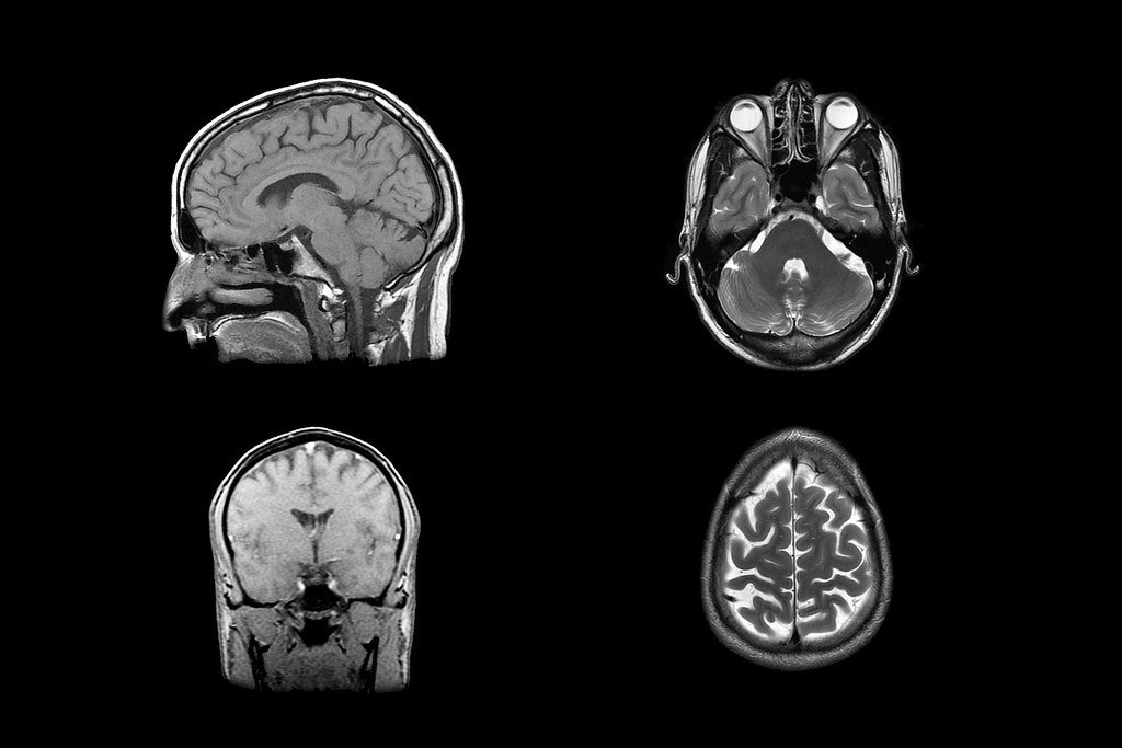 Brain MRI Image